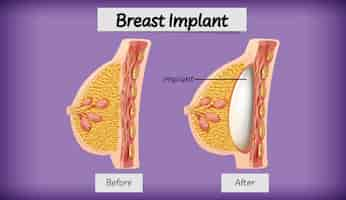 Vetor grátis anatomia do implante mamário humano