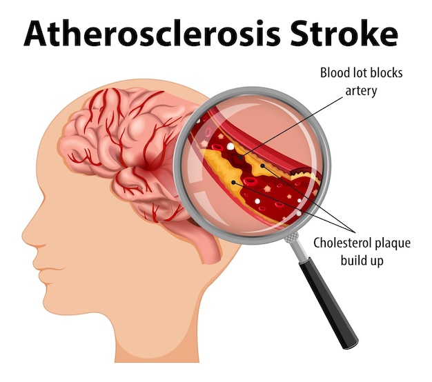 Anatomia humana com acidente vascular cerebral de aterosclerose