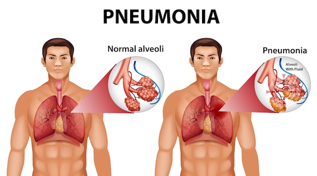 Anatomia humana mostrando pneumonia