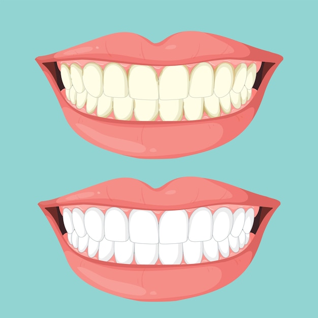 Antes e depois do branqueamento dos dentes