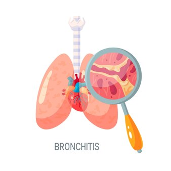Bronquite doença conceito diagnóstico pulmonar