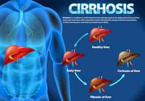 Vetor grátis cartaz informativo sobre doença hepática alcoólica cirrose