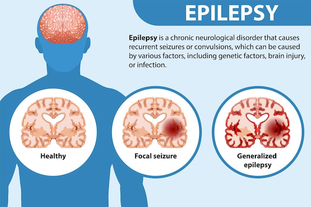 Vetor grátis cartaz informativo sobre epilepsia