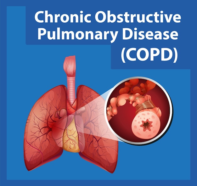 Ciência da educação da anatomia humana copd infográfico