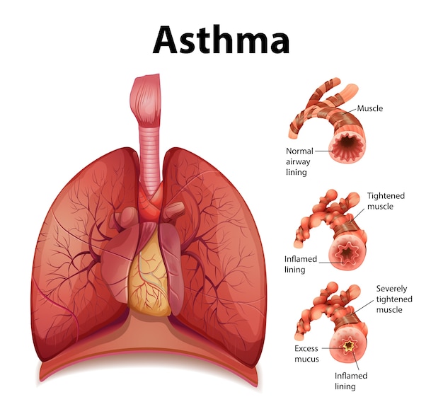 Comparação de pulmão saudável e pulmão asmático Vetor grátis