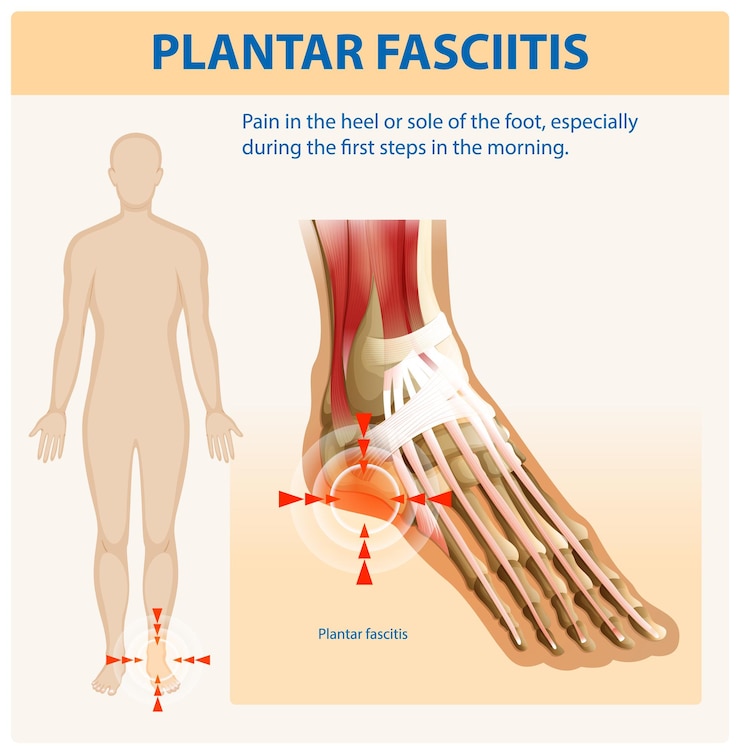 Vetor grátis compreendendo a fascite plantar e a dor no pé