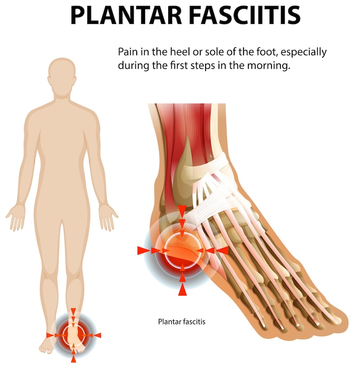 Vetor grátis compreendendo a fascite plantar e a dor no pé