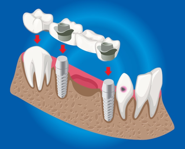 Conceito de odontologia protética isométrica com ponte dentária usada para cobertura de dentes ausentes