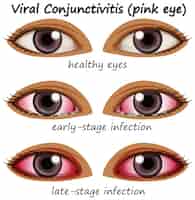Vetor grátis conjuctivite viral nos olhos humanos