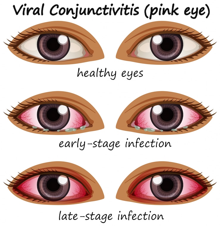 Vetor grátis conjuctivite viral nos olhos humanos