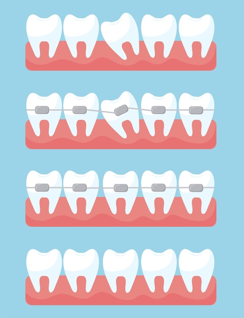 Vetor grátis conjunto de dente com aparelho ortodôntico