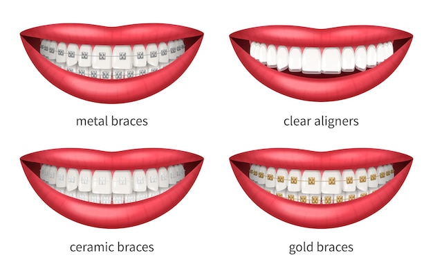 Conjunto de ícones de aparelhos dentários com lábios humanos realistas ilustração vetorial isolada