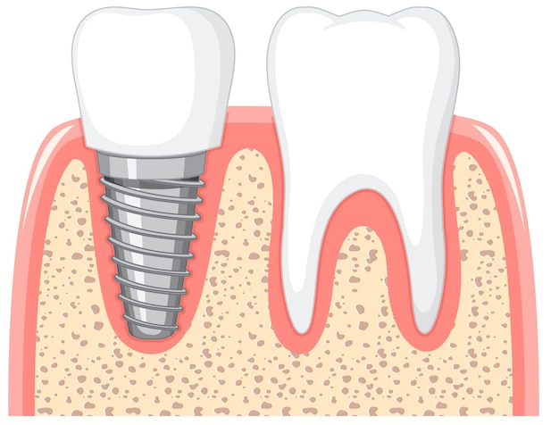 Vetor grátis dente saudável e implante dentário em goma no fundo branco