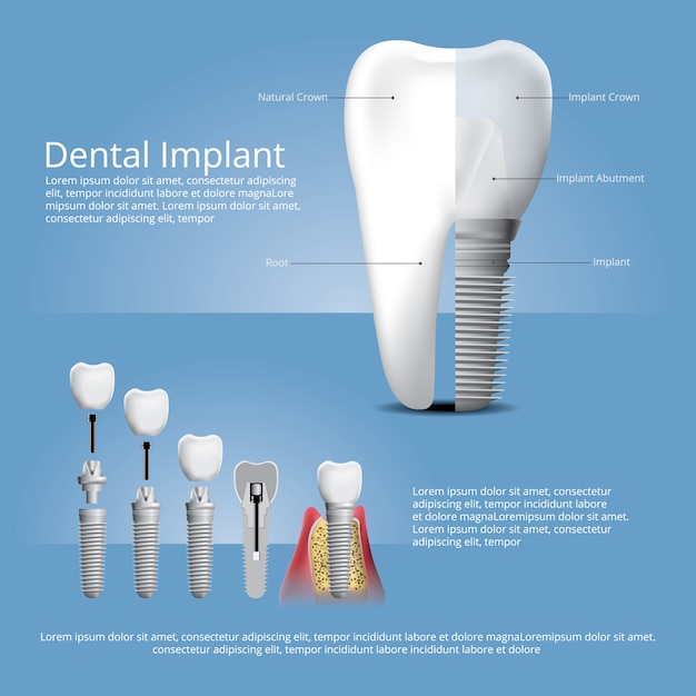 Vetor grátis dentes humanos e modelo de implante dentário