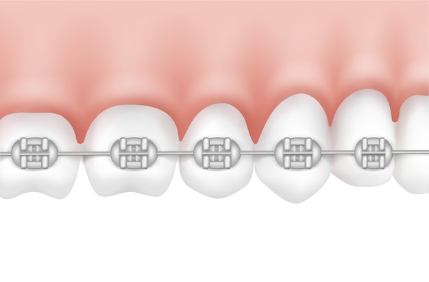 Dentes humanos vetoriais com vista lateral de aparelho de metal isolado no fundo branco