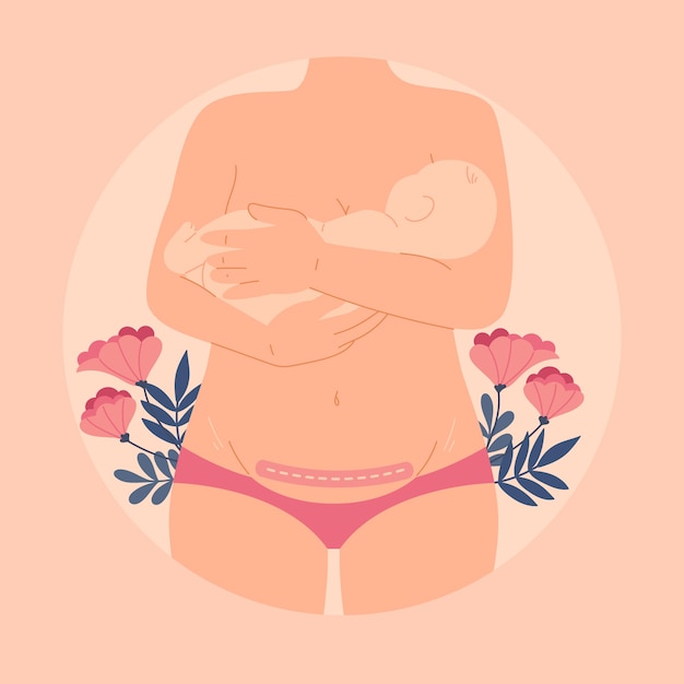 Desenho plano cesárea desenhado à mão