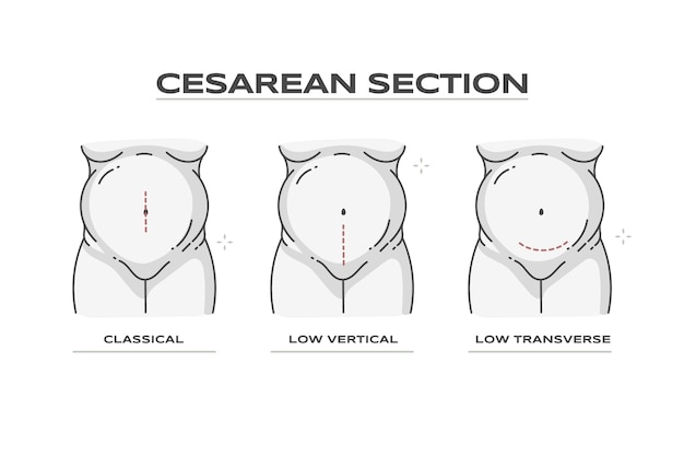 Vetor grátis desenho plano cesárea desenhado à mão