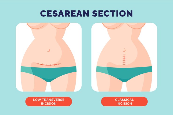 Vetor grátis desenho plano cesárea desenhado à mão