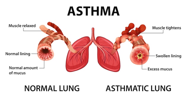 Diagrama de asma com pulmão normal e pulmão asmático Vetor grátis