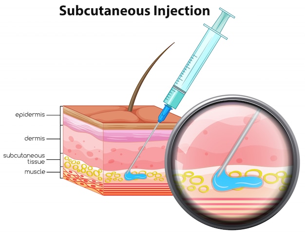 Vetor grátis diagrama de injeção subcutânea de pele