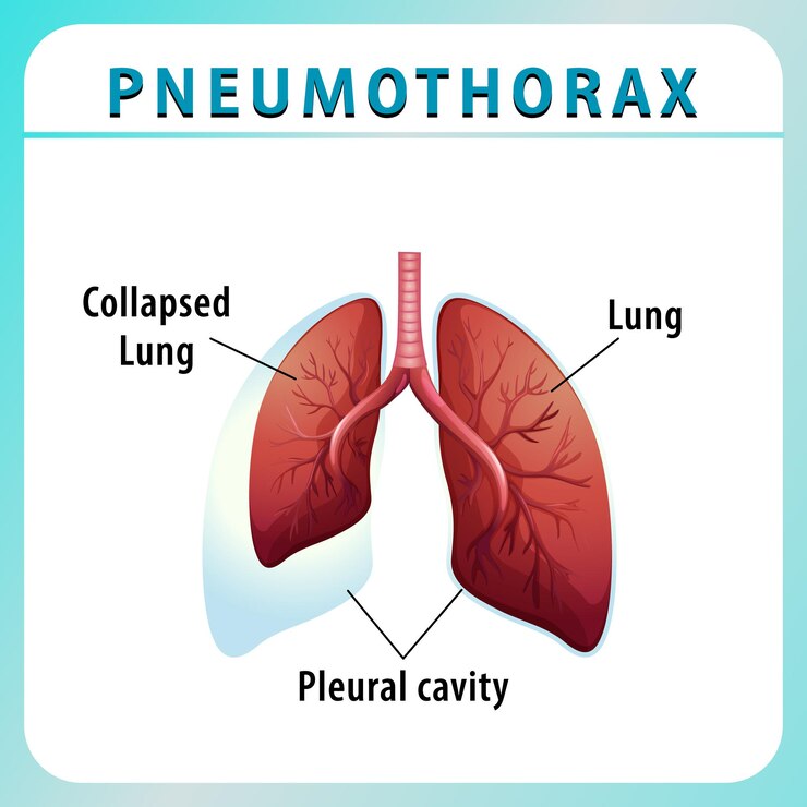 Vetor grátis diagrama de pneumotórax com pulmão colapsado e pulmão saudável