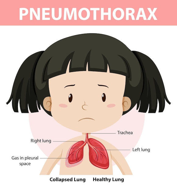 Vetor grátis diagrama de pneumotórax da anatomia humana