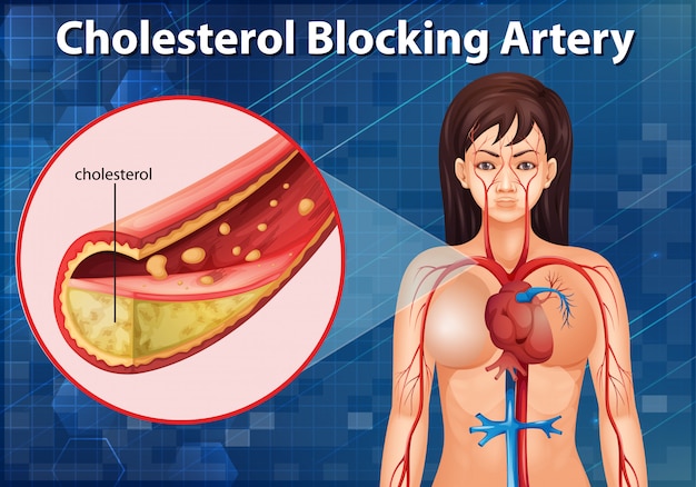 Diagrama mostrando a artéria bloqueadora de colesterol no corpo humano