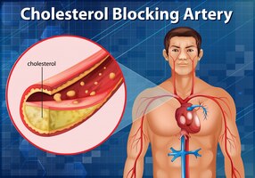 Diagrama mostrando a artéria bloqueadora de colesterol no corpo humano