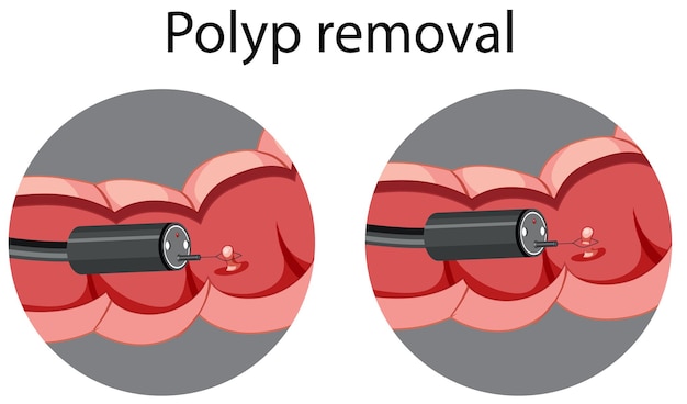 Diagrama mostrando a remoção de pólipos