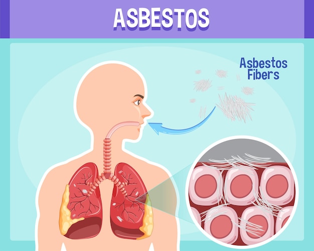 Diagrama mostrando asbestose nos pulmões