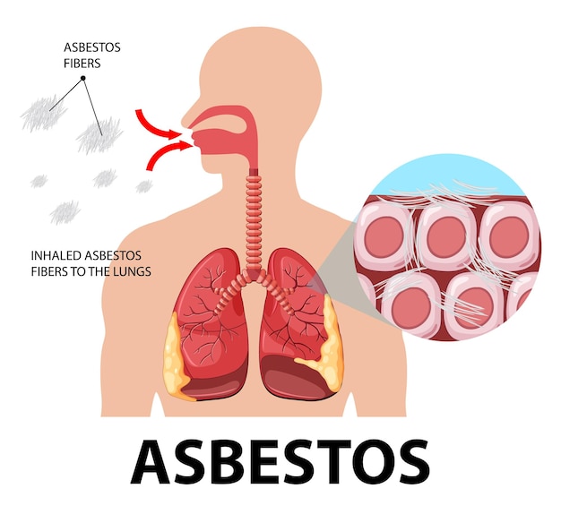 Vetor grátis diagrama mostrando asbestose nos pulmões