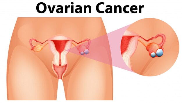 Vetor grátis diagrama mostrando câncer de ovário