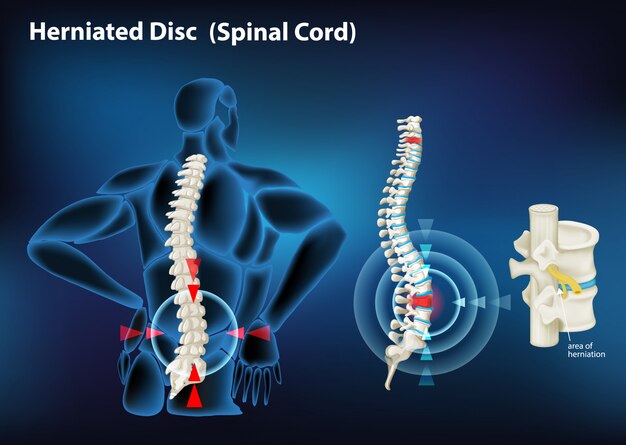 Diagrama mostrando hérnia de disco em humanos