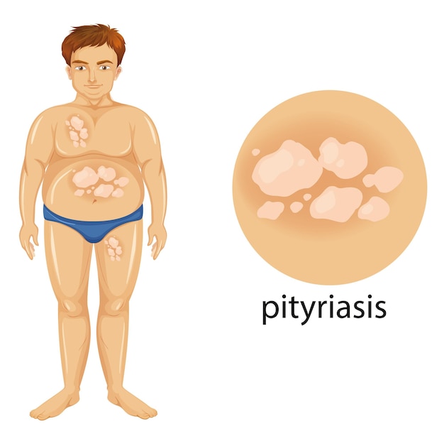 Diagrama mostrando homem com pitiríase