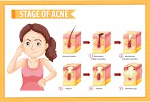 Vetor grátis estágios da anatomia da acne na pele com uma mulher fazendo pose estressante