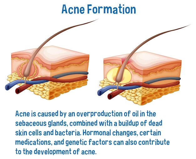 Vetor grátis explicação das informações sobre formação de acne