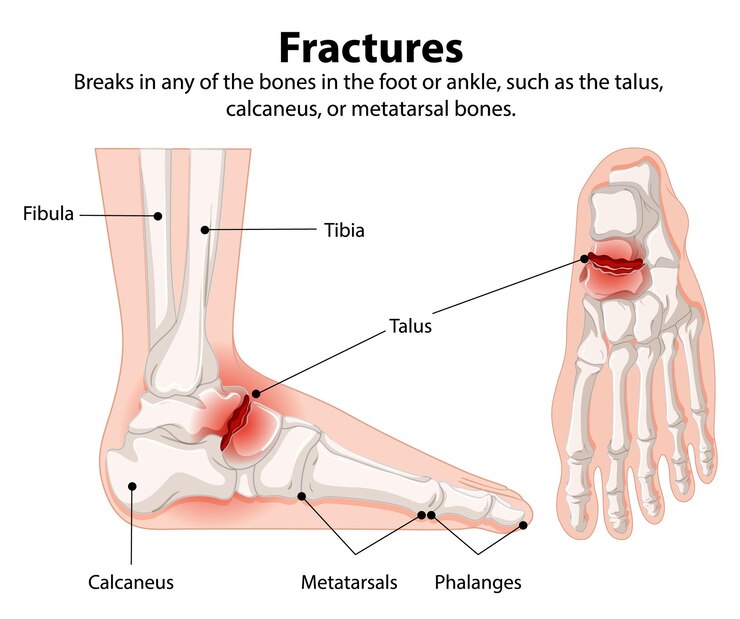 Vetor grátis fracturas do pé e do tornozelo