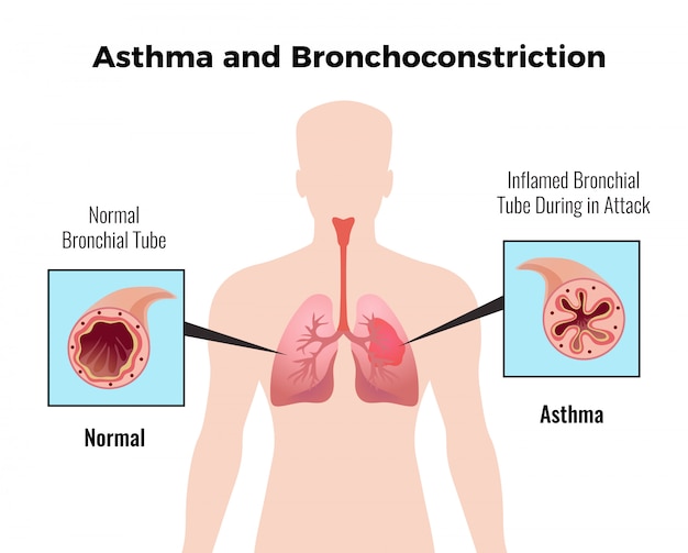 Gráfico educativo médico de ataque de asma com representação plana e brônquica de tubo bronquial normal e inflamado