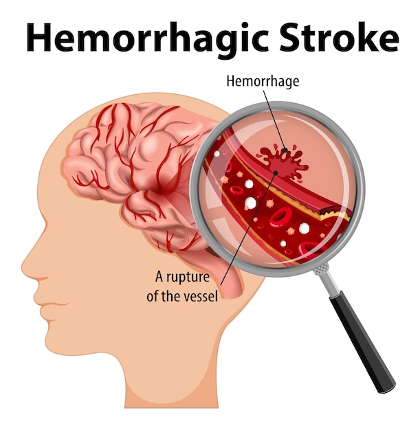 Vetor grátis humano com avc hemorrágico