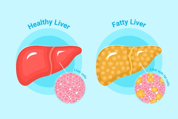 Ilustração de fígado gordo de design plano desenhado à mão