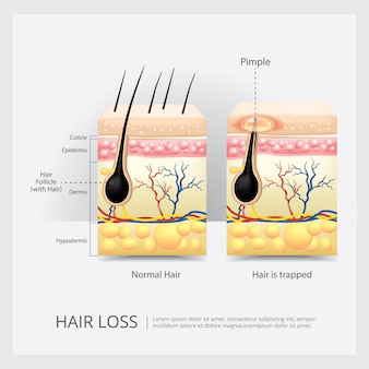 Ilustração de vetor de estrutura de perda de cabelo