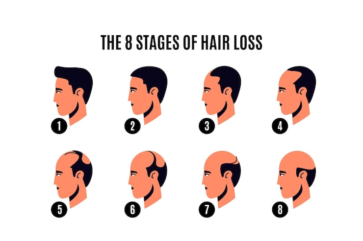 Vetor grátis ilustração dos estágios da queda de cabelo desenhada à mão plana