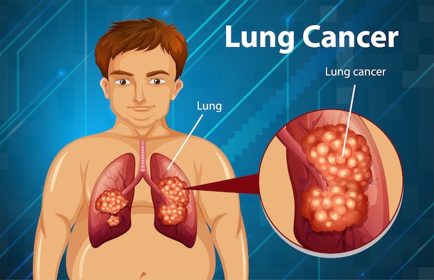 Ilustração informativa de câncer de pulmão