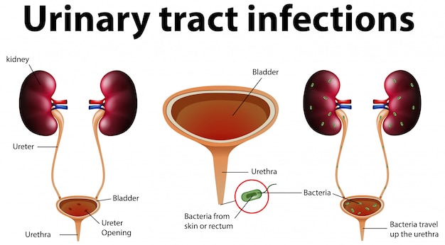 Vetor grátis ilustração informativa de infecções do trato urinário