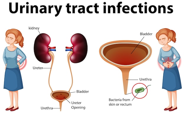 Vetor grátis ilustração informativa de infecções do trato urinário