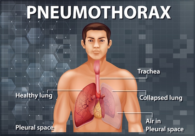 Ilustração informativa de pneumotórax