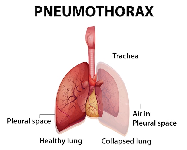 Ilustração informativa de pneumotórax