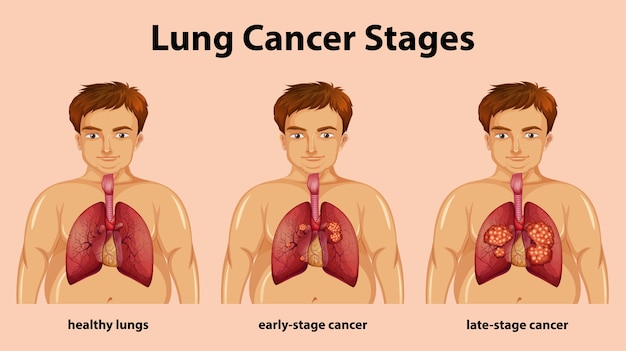 Ilustração informativa dos estágios do câncer de pulmão