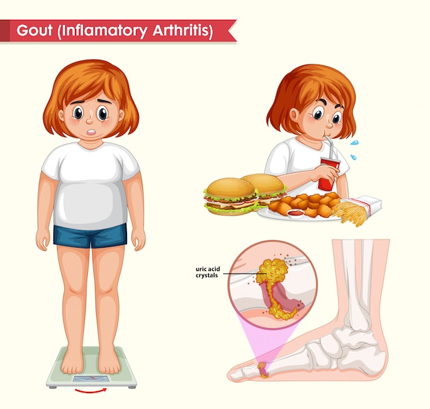 Ilustração médica científica da artrite da gota