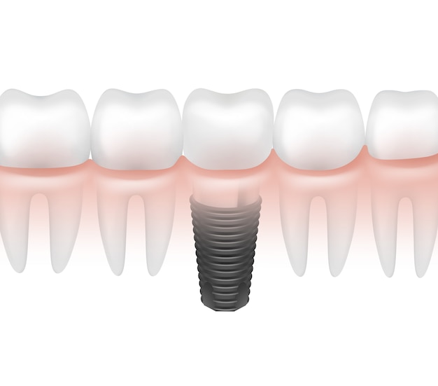 Implante dentário de metal de vetor entre outros dentes em vista lateral da gengiva, isolado no fundo branco